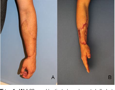 phalloplasty results 2018